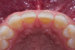 Palatal view revealing the dimensional prominence of the cuspids relative to the central incisors, highlighting the challenge to get them to mimic smaller lateral incisors.
