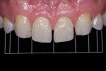 Close-up maxillary retracted view with a golden proportion contraster in place to plan space closure. The shifted grid position prompted the decision to close the diastemata with the addition of composite to the mesial aspect of tooth No. 8 and the distal aspect of tooth No. 9.