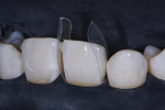 Mylar sectional posterior matrices (Transparent Restoration Matrices, Kormed) were trimmed to accommodate the interproximal bone and seated vertically, beginning with tooth No. 9. Insertion of the matrices between the teeth and the rubber dam provided the cervical seal.