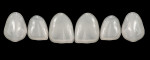 Figure 1  Set of Edelweiss™ Composite Veneers showing a glossy surface resulting from laser vitrification.