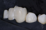 After the tooth was etched and the adhesive was applied and cured, the matrices were overmolded with flowable and regular viscosity composites (Filtek™ Supreme Ultra, 3M) that were then simultaneously light cured.