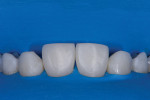 Facial view of both central incisors shaped. After the rubber dam was removed, and the patient was seated to confirm the midline position, a medium gauge rubber dam (DermaDam™, Ultradent) was placed for the remainder of the treatment.