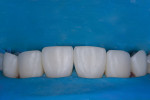 Following the overmolding and shaping of teeth Nos. 5, 6, 11, and 12, teeth Nos. 5, 6, 8, 9, 11, and 12 were further refined with coarse abrasive discs (Sof-Lex™, 3M) and trimmers (Contours™ Coarse Anatomy Trimmers, Clinician’s Choice).