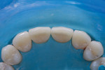 A postoperative palatal view permits visualization of the additional tooth volume and new proportions.