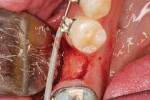 Lingually placed crestal incision.