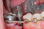 Alignment and depth check for implant position.