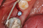 Fixture mount and implant placement at 35 Ncm initial stability.