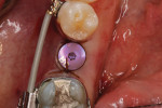 Placement of healing abutment and primary closure with chromic sutures.