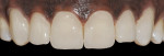 Figure 3  Posttreatment view, using one-session prefabricated Edelweiss composite veneers.