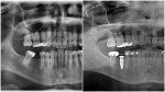Before and after panoramic radiographs with the latter taken at the 12-month osseointegration check appointment.