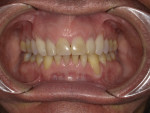 Pretreatment retracted photograph showing gingival recession and compromised esthetics in the anterior region.