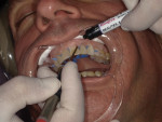 Placement of gingiva-colored bioactive composite restorative material in areas of recession.