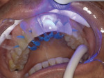 The facial surfaces of the teeth were each air dried for 3 seconds and exposed to an LED curing light for 5 seconds.