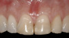 Figure 14  Periapical radiograph of fractured maxillary left canine with a calibrated point (15-mm markings) demonstrating extent of attachment loss on mesiobuccal aspect of the tooth. Similar probing was present on the distobuccal aspect of the tooth.
