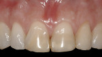 Figure 4  Preoperative status showing two large, unesthetic composite restorations.