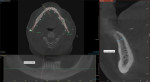 Diagnostic CBCT scan identifying a limited 5.7 mm of available bone width in the sagittal view.