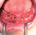 Placement of four 2.4 mm × 10 mm implants torqued to 35 Ncm.