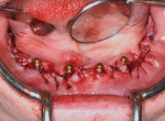 Closure of surgical site using continuous interlocking and interrupted sutures.
