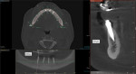 Immediate postoperative CBCT scan showing implant placement in the tooth No. 27 position identified in the preoperative diagnostic CBCT scan.