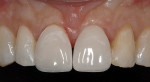 Figure 6  The prefabricated Edelweiss veneers were trimmed around the cervico-proximal profile and internally as well to create an optimal alignment with neighboring teeth.