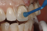 Figure 7  The veneers are placed following conventional adhesive procedures but using a restorative composite material for easier placement.