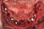 Fig 1. With the use of an anatomically correct surgical guide template, five regular connection bone-level tapered implants and one regular neck tissue-level implant were placed with excellent insertion torques (all >35 Ncm). Note thin buccal plates (≤1 mm) for all sites. Buccal gaps were planned virtually to be 2 mm or greater to accept slowly resorbing bone graft material.