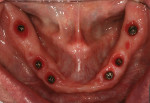Fig 6. On the day of insertion of the final prosthesis 12 months post-surgery, soft-tissue thickness was evident in the mandibular jaw, demonstrating “phenotype conversion.”