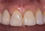 Fig 8. Pretreatment condition showing splinted teeth to stabilize fractured left central incisor. The gingival recession on both lateral incisors was not an esthetic concern to the patient.