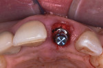Fig 9. Implant was placed utilizing flapless placement, palatal positioning, and buccal gap bone grafting.
