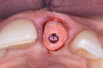 Fig 12. PEEK healing abutment attached to implant to complete the surgical procedure and seal off the socket.