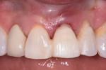 Fig 13. Original tooth No. 9 bonded back into position as a provisional restoration.