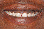 Fig 1. Initial presentation in 2010. The patient was diagnosed with excessive gingival display from teeth Nos. 6 through 11.