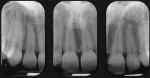 Fig 3. Radiographic films showed the interdental bone levels from teeth Nos. 6 through 11 were at the level of the adjacent CEJs.