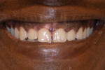 Fig 9. Seven years after the initial surgery. The gingiva showed relapse toward the initial presentation.