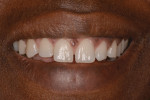 Fig 14. Patient’s smile at 3-month postoperative follow-up after second ECL procedure.