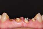 Fig 1. Condition of the maxillary incisor teeth prior to crown lengthening.