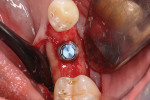 Fig 1. Example of a thin buccal bone (<1 mm) facial to an implant at site No. 19 (occlusal view). The exact thickness of buccal bone that forecasts successful implantation has yet to have been determined.