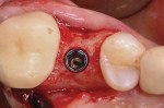 Fig 2. Example of a thick buccal bone (≥2 mm) facial to an implant at site No. 4 (occlusal view).