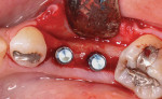 Fig 3. This photograph shows an example of 1 mm to 2 mm buccal bone facial to an implant at sites Nos. 19 and 20 (occlusal view), an amount that is generally considered appropriate after implant placement.
