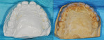 Figure 5  Comparisons of maxillary cast before and after wax-up.