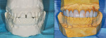 Figure 6  Comparisons of maxillary cast before and after wax-up.