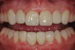 Fig 6. Completed RBFPDs comprising zirconia frameworks and overlaying veneers.