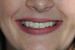 Fig 7. Final smile, post-treatment.