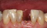 Fig 8. Pretreatment occlusal view. The lower central incisor was fractured at the gumline. The patient is asymptomatic.