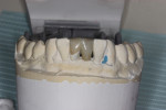 Fig 11. Frontal view of the completed RBFPD on a mandibular cast.
