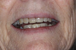 Fig 12. Completed RBFPD with patient smiling.