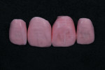 Fig 6. The unsintered restorations are infiltrated to achieve the final color and translucency.