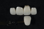 Fig 7. The unsintered restorations are infiltrated to achieve the final color and translucency.