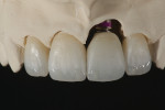 Fig 8. The final restorations are fitted to the model to check fit.