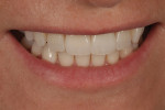 Fig 12. The patient’s smile 2 weeks after insertion.